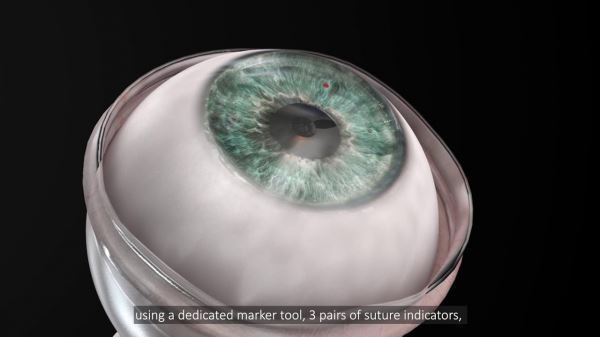 Что такое искусственная роговица глаза и зачем она нужна?